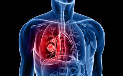 lung cancer