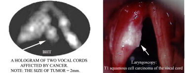 vocal cord cancer
