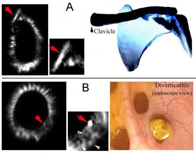 fig3 clavicle polyp